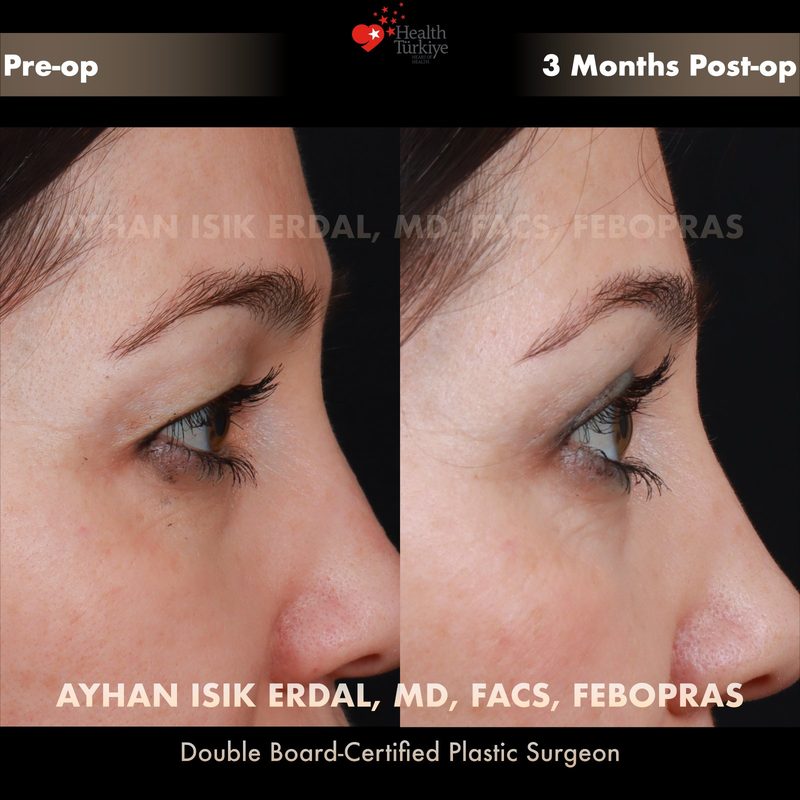 Upper blepharoplasty before and after - oblique view