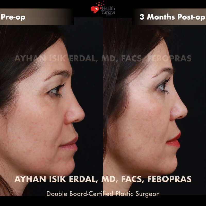 Upper blepharoplasty before and after - side view