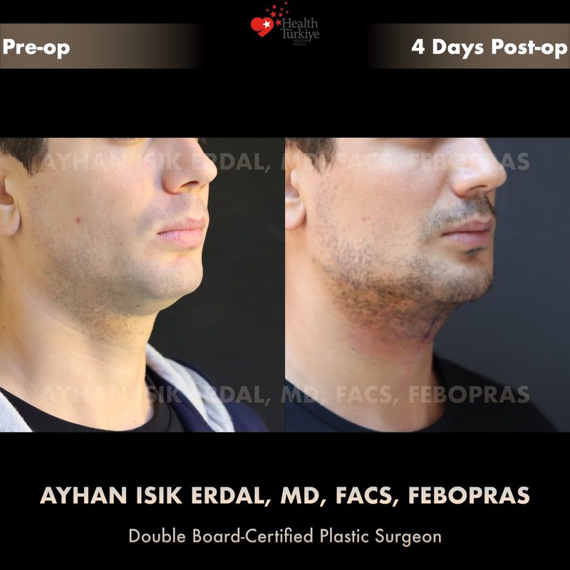 Chin liposuction before and after - oblique view