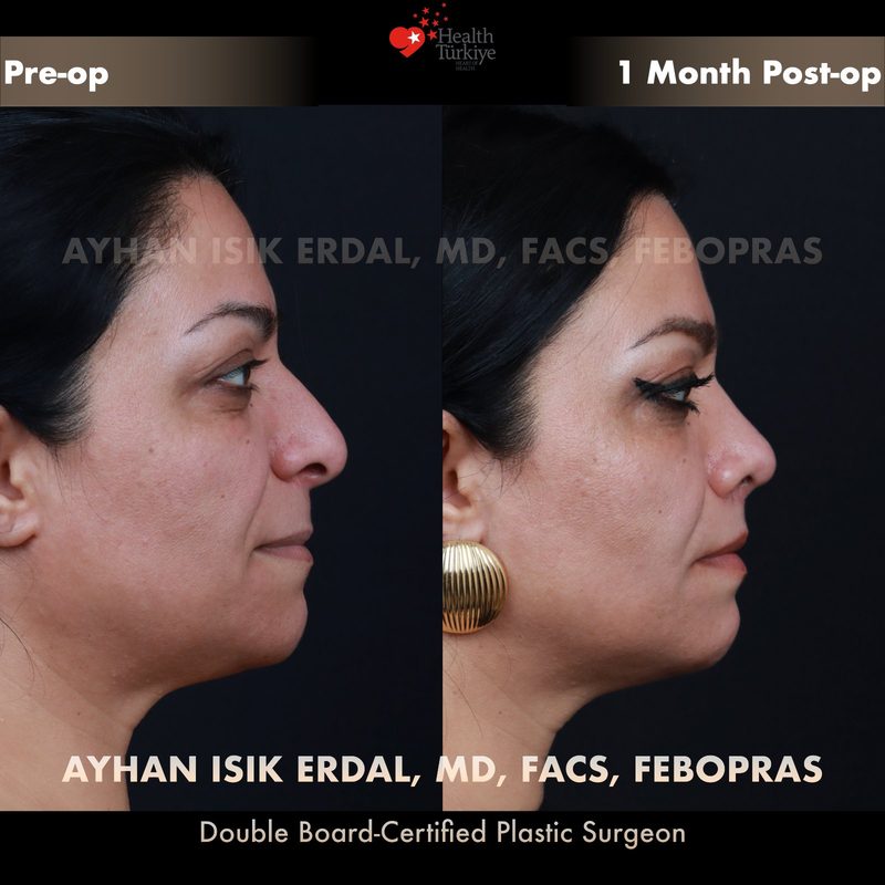 Lip lift before and after - side view