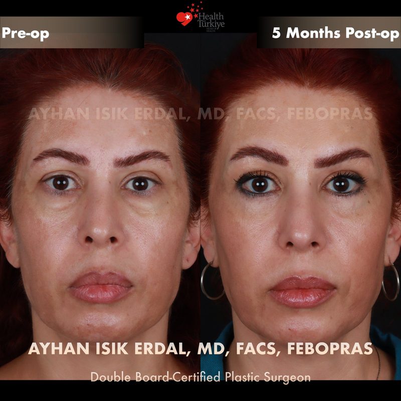 Lower blepharoplasty before and after - front view