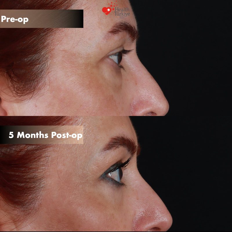 Lower blepharoplasty before and after - oblique view