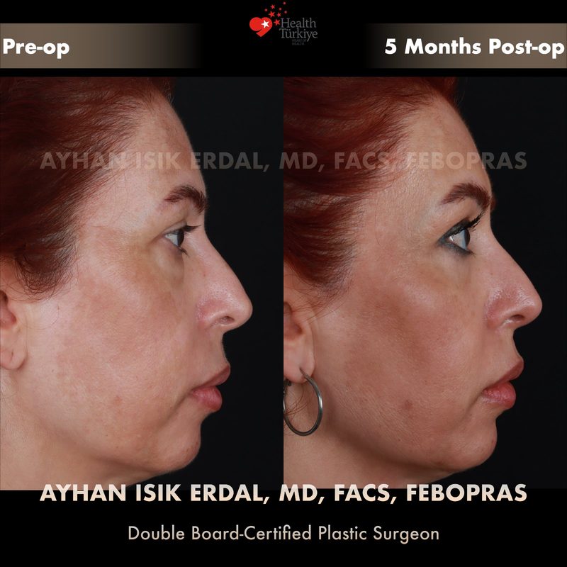 Lower blepharoplasty before and after - side view