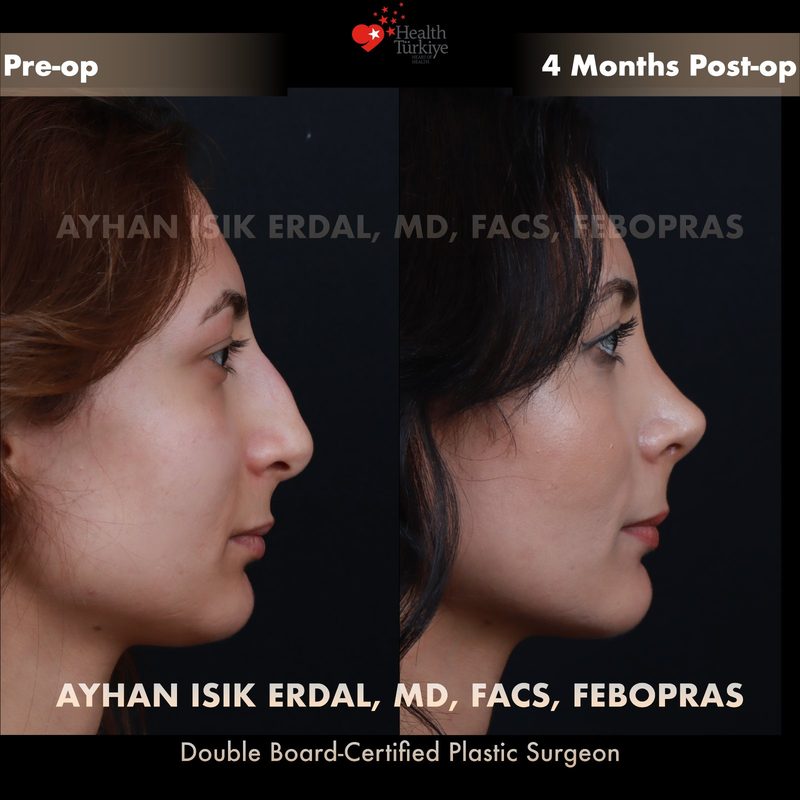 Rhinoplasty before and after - side view
