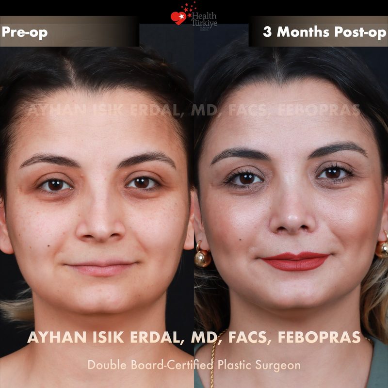 Rhinoplasty before and after - front view