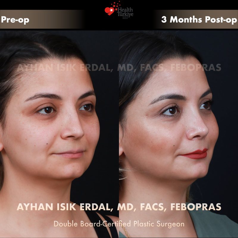 Rhinoplasty before and after - oblique view