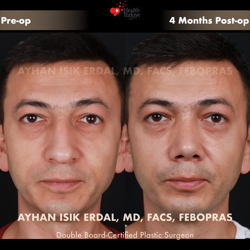 Rhinoplasty before and after