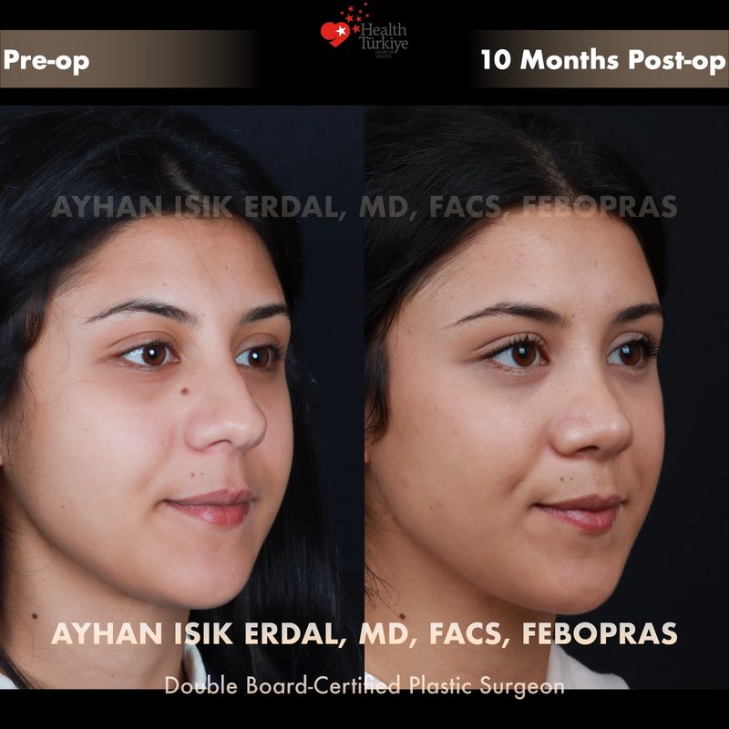 Rhinoplasty before and after