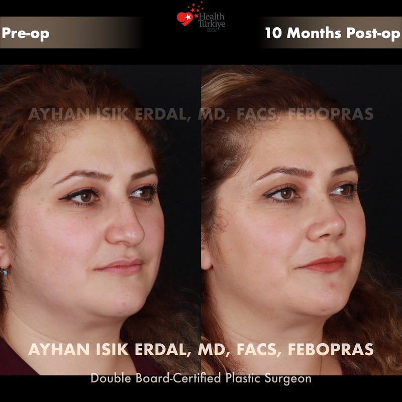 Rhinoplasty before and after