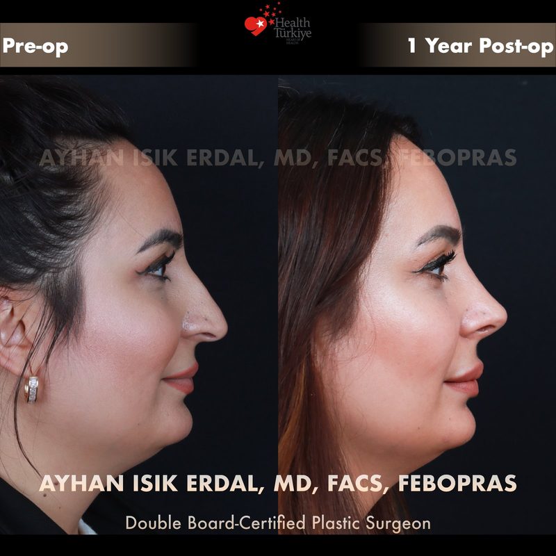 Rhinoplasty before and after