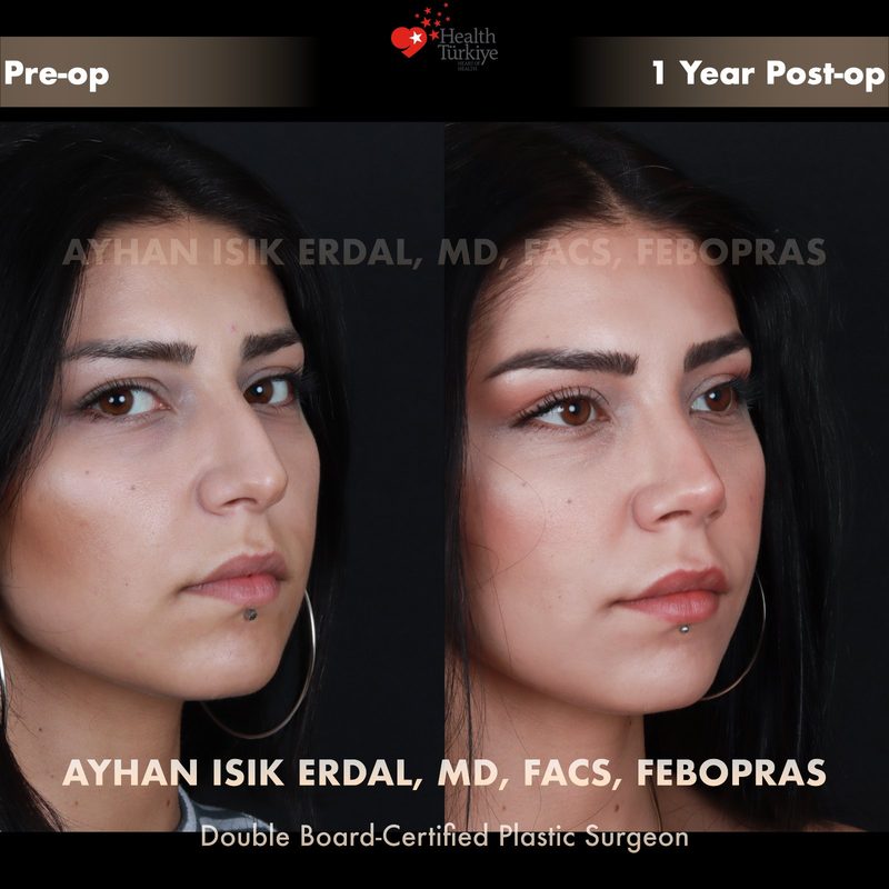 Rhinoplasty before and after
