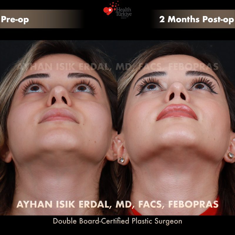 Revision rhinoplasty before and after