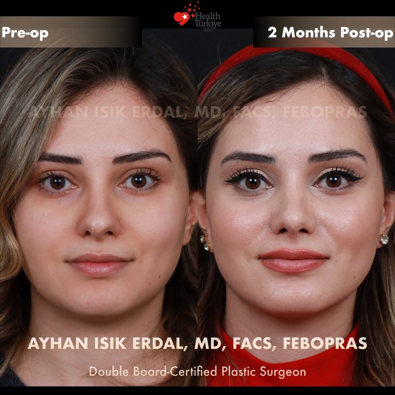 Revision rhinoplasty before and after