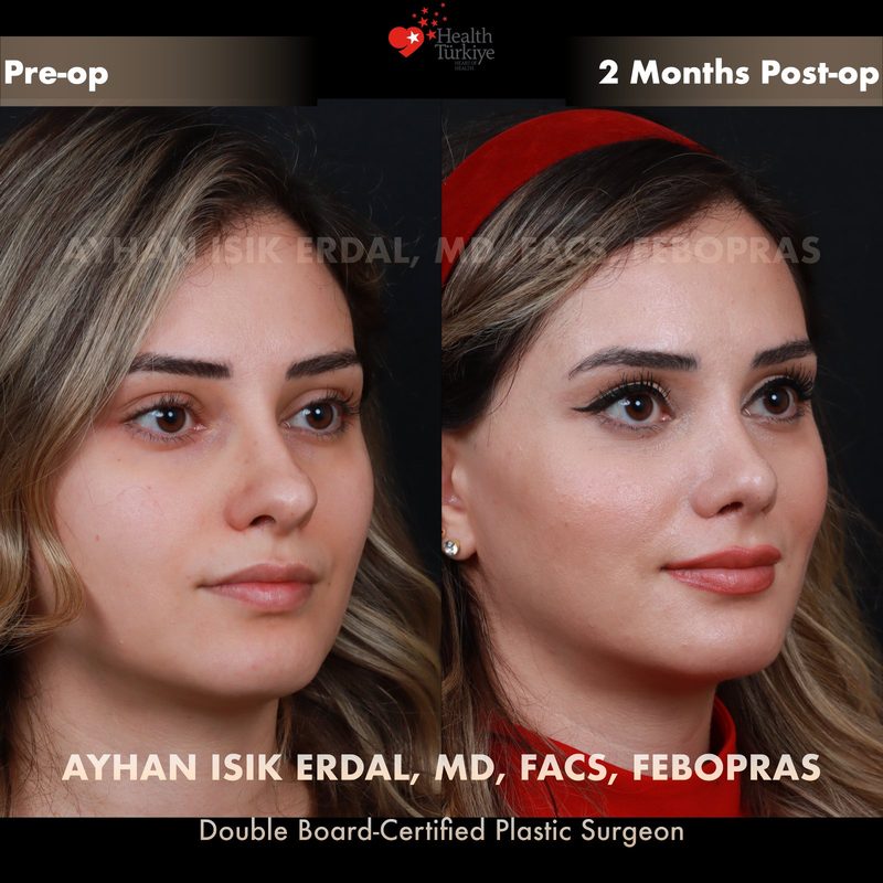 Revision rhinoplasty before and after