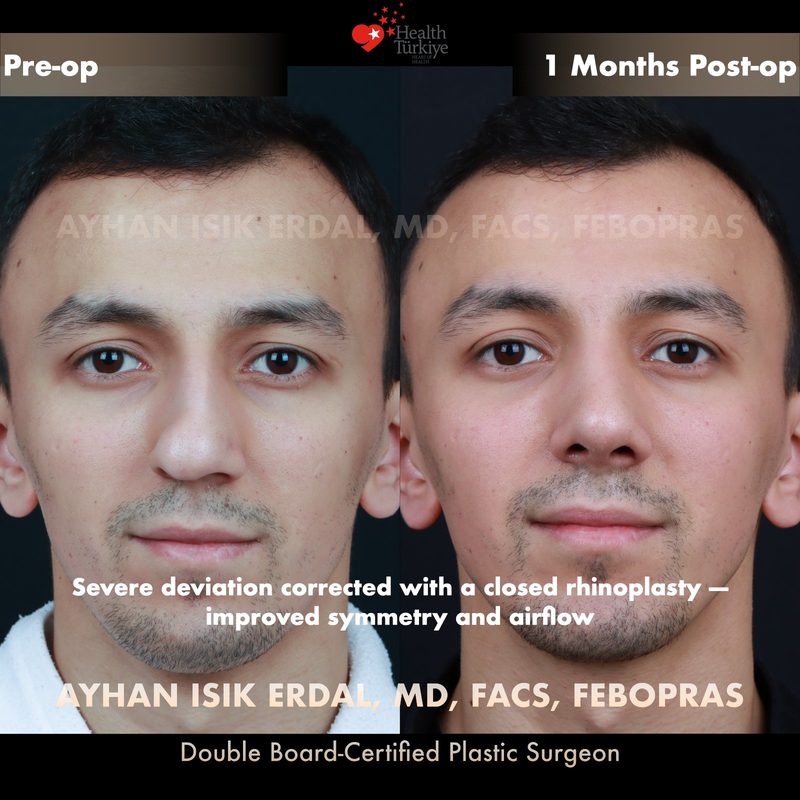 Rhinoplasty deviation correction - front view