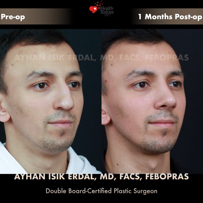 Rhinoplasty deviation correction - oblique view