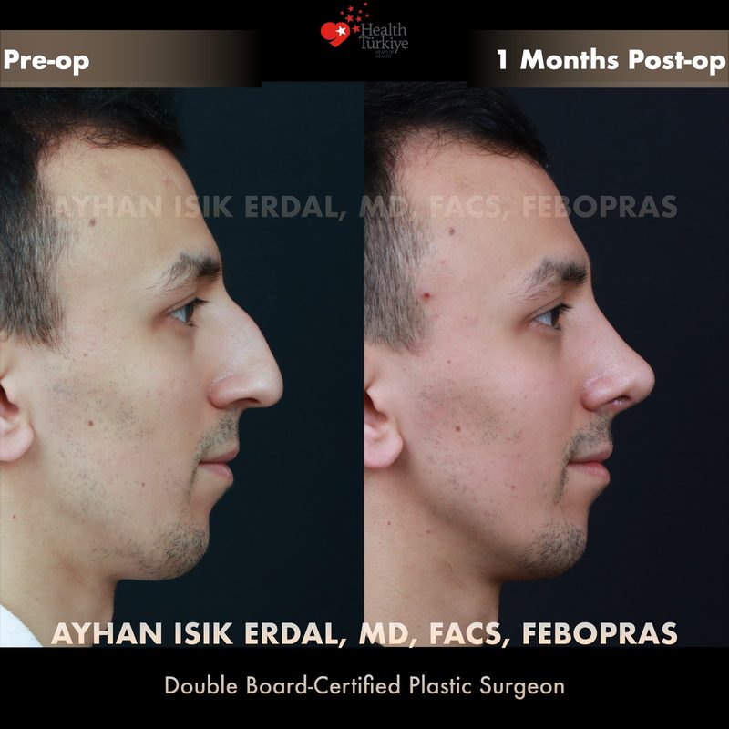 Rhinoplasty deviation correction - side view