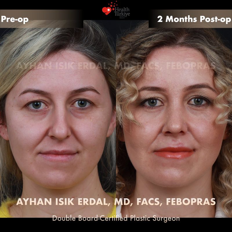 Rhinoplasty before and after - front view