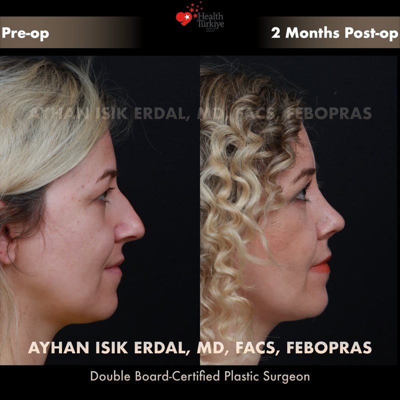 Rhinoplasty before and after - side view