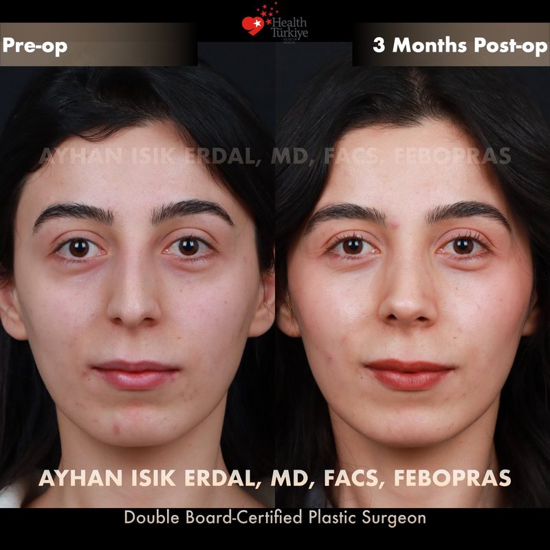 Rhinoplasty before and after - front view