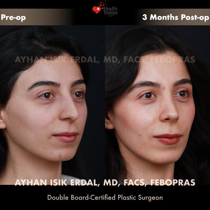 Rhinoplasty before and after - oblique view