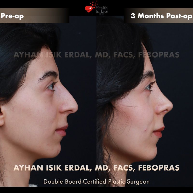 Rhinoplasty before and after - side view