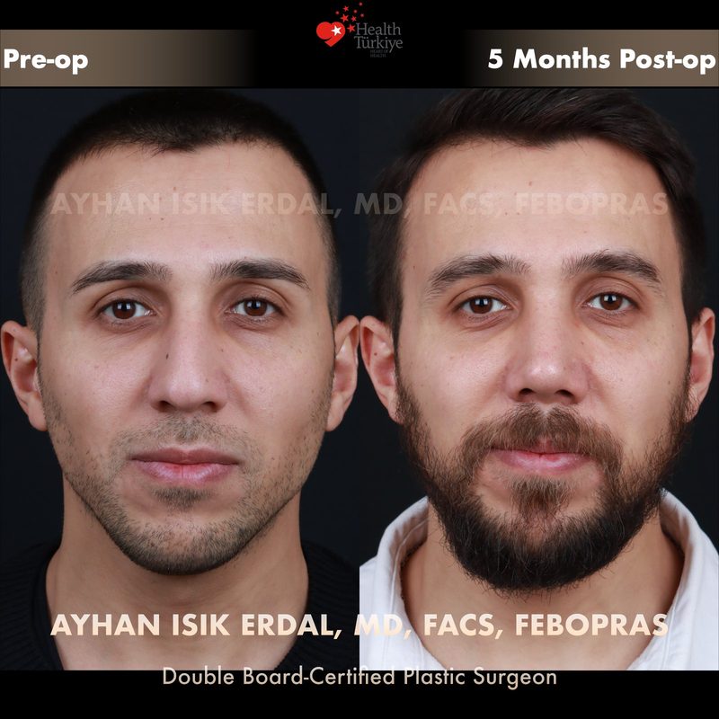Rhinoplasty before and after - front view