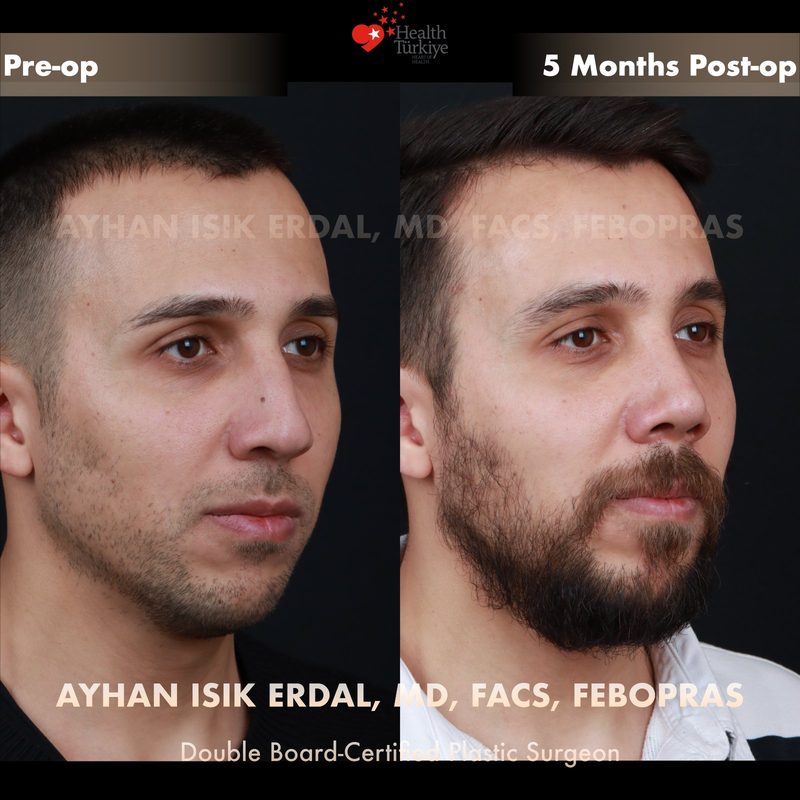 Rhinoplasty before and after - oblique view