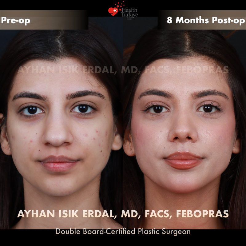 Rhinoplasty before and after - front view