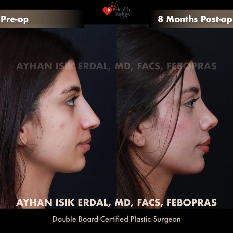 Rhinoplasty before and after - side view