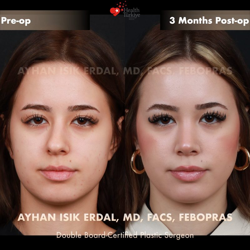 Rhinoplasty before and after - front view