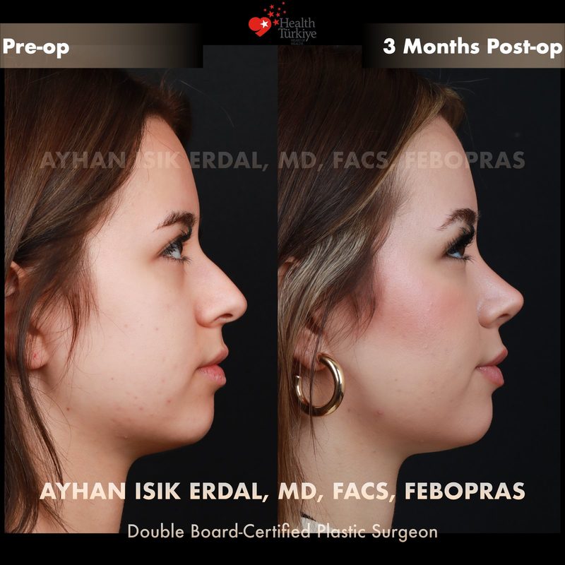 Rhinoplasty before and after - side view