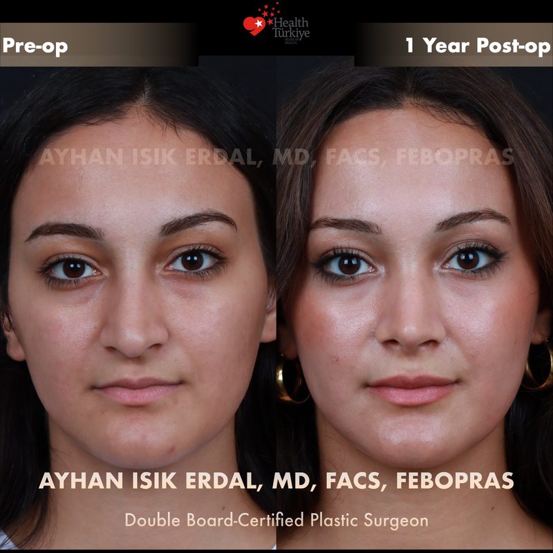 Rhinoplasty before and after - front view
