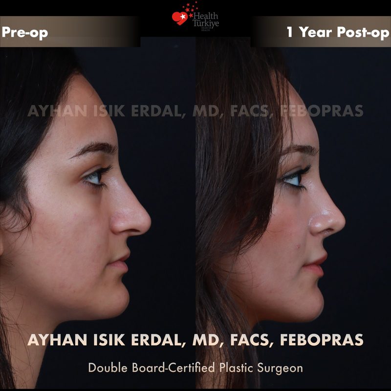 Rhinoplasty before and after - side view