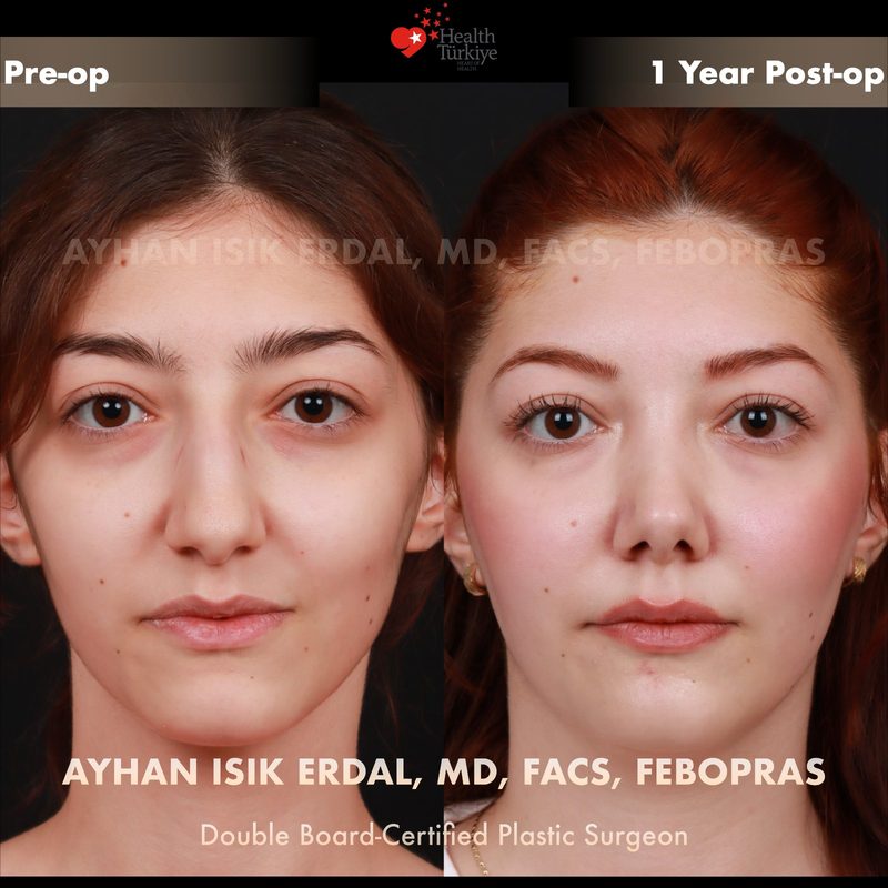 Rhinoplasty before and after - front view