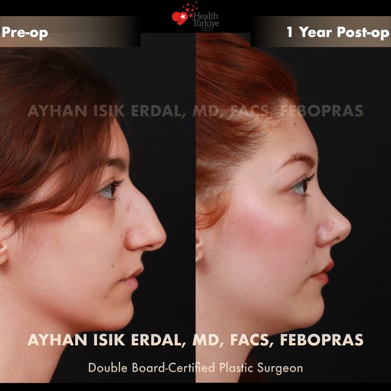 Rhinoplasty before and after - side view